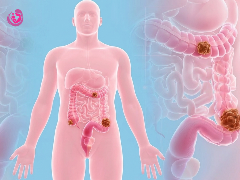 Colon Cancer Stages
